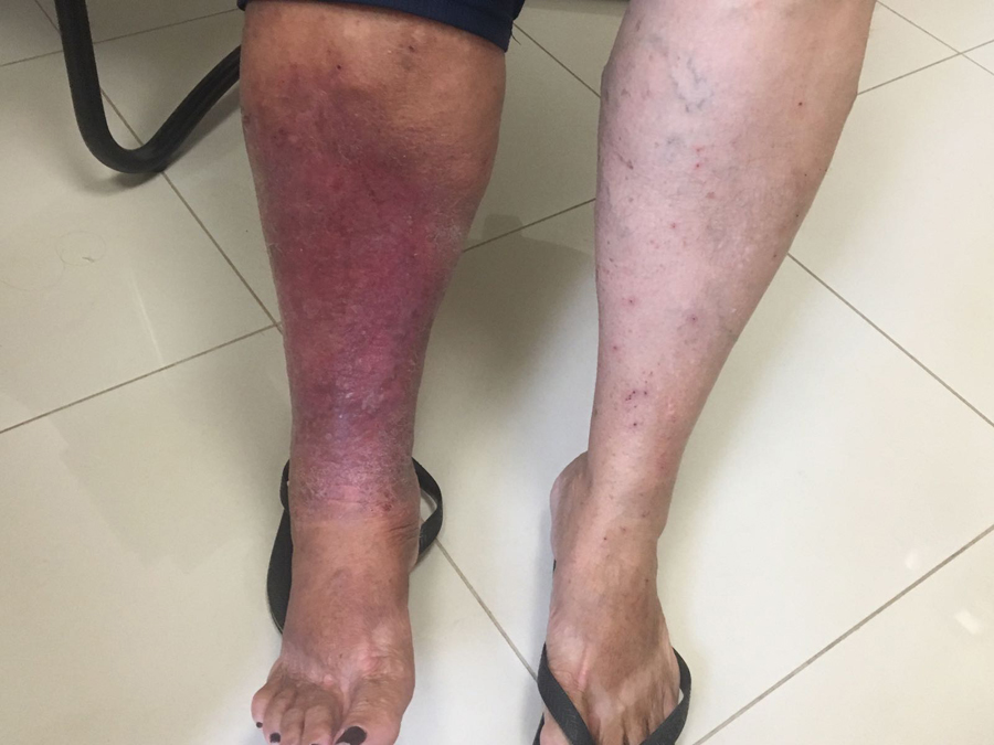 Você conhece as causas da Erisipela?