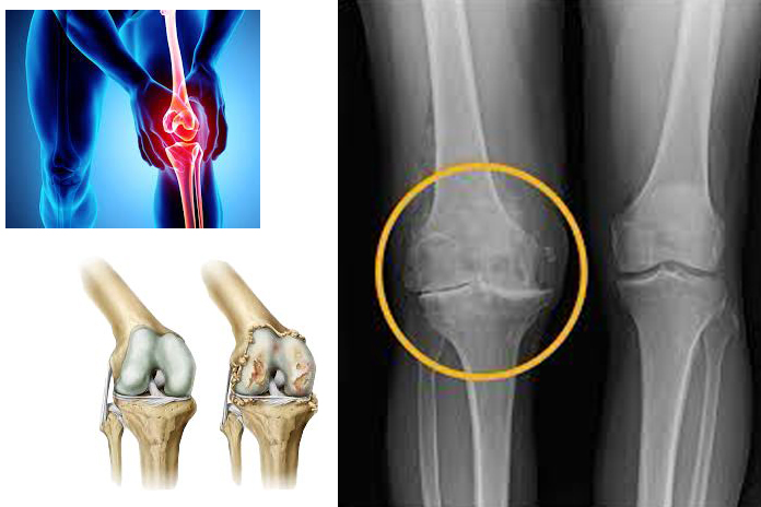A osteoartrose do joelho
