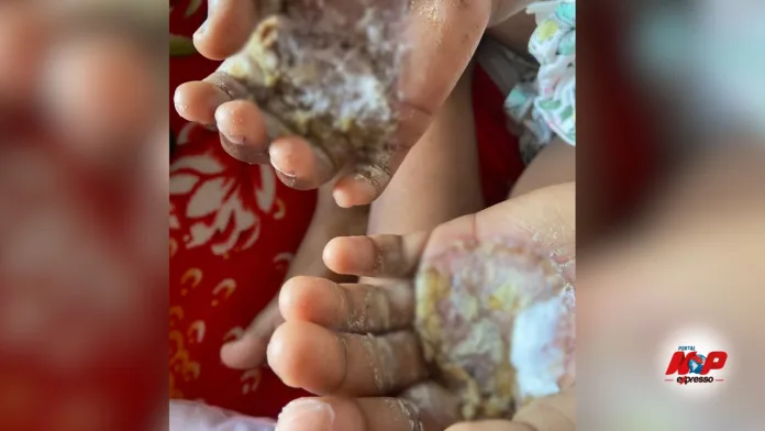 Mãe é presa por torturar e obrigar filha a segurar ovos fervendo